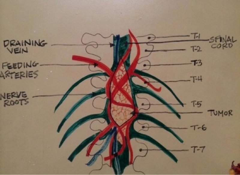 The unforgettable tumor !!!